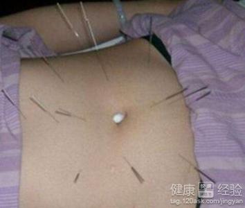 针灸减肥有效吗？针灸减肥穴位与效果全解析