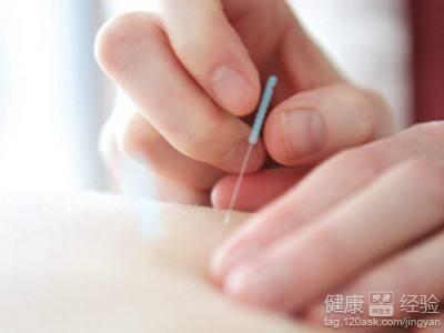 針灸減肥有效嗎？正確方法與風險須知