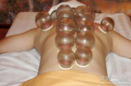 拔罐減肥會反彈嗎？正確減肥方法與後續對策