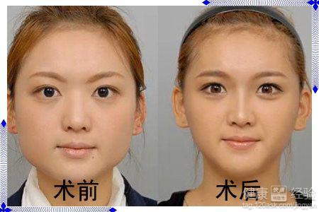肉毒瘦臉针費用影響因素解析