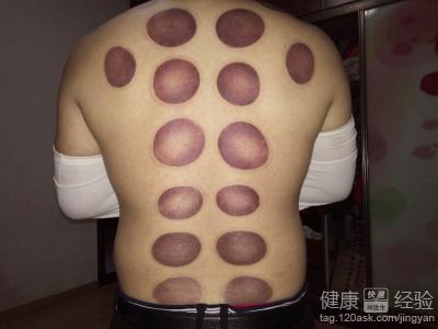 拔火罐減肥的注意事項與原理說明