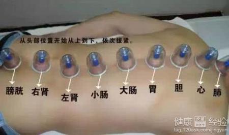拔罐後皮膚顏色如何鑑別？掌握這幾點瞭解身體狀況