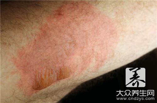 皮膚過敏能吃牛肉嗎?牛肉是發物嗎