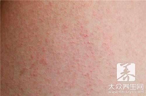 出麻疹要注意什麼?寶寶照護必讀