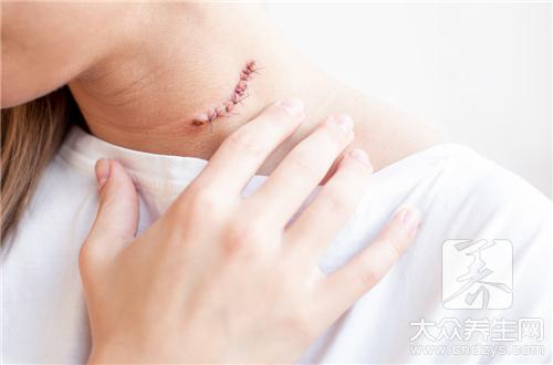 脖子右側淋巴結疼痛的注意事項
