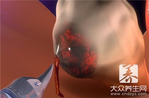 甲狀腺囊腫患者能否食用海鮮?飲食注意事項完整指南