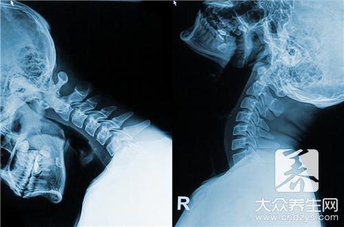 頸椎病患者飲食禁忌：哪些食物不能吃？
