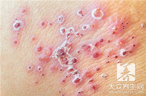 荨麻疹禁忌:日常饮食与用药注意事项
