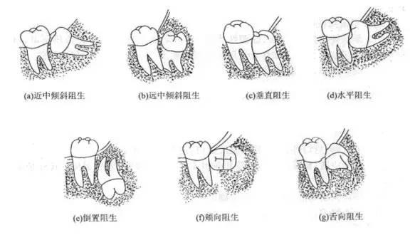 智齿拔了到底会不会瘦脸？真相與科學解讀